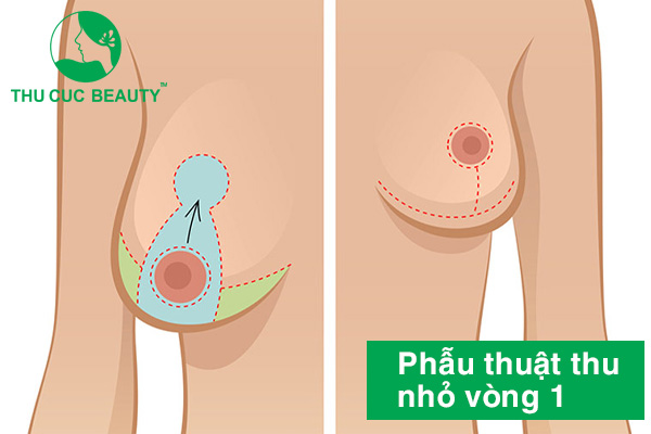 Phẫu thuật thu nhỏ ngực (vòng 1) phì đại