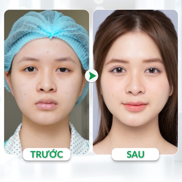 Phẫu thuật sụp mí mắt (nâng mí) 6 cat mi mat e1784107979934