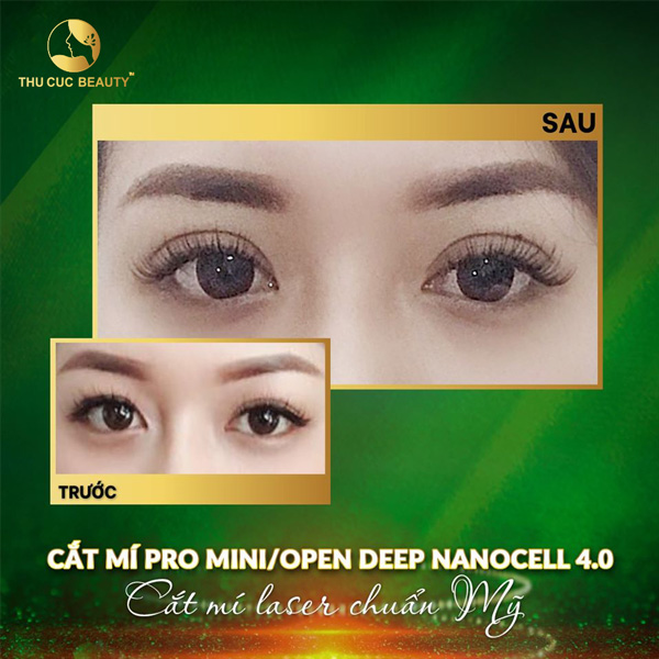 Cắt mí Pro Mini/Open Deep NanoCell 4.0