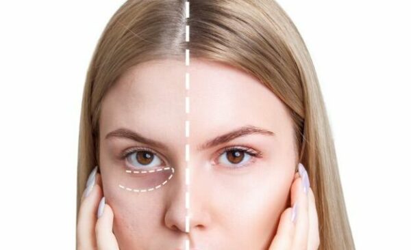 cay mo hoc mat sau la gi e1767929567274