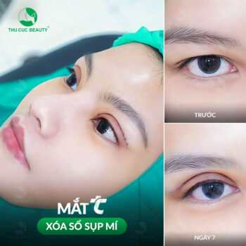 Phẫu thuật cắt mắt sụp mí giá bao nhiêu?