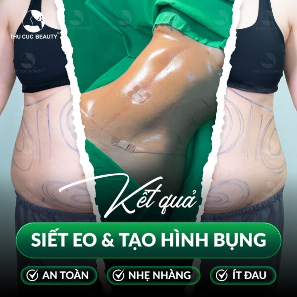 Hút mỡ tạo eo thon 1 hut mo bung TC e1784086766296