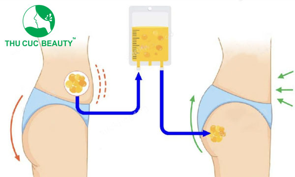 Nâng mông bằng mỡ tự thân