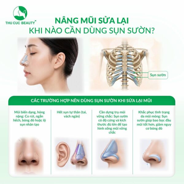 Nâng mũi sụn sườn 1 nang mui sun suon 1 e1784111684617