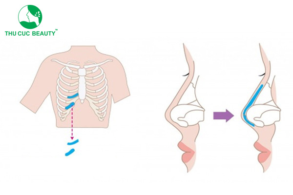 Nâng mũi sụn sườn