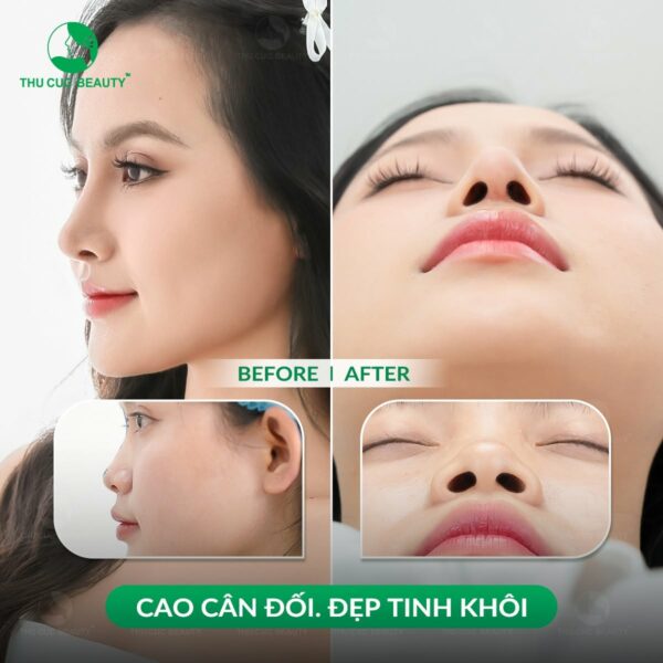 phau thuat thu nho dau mui dep e1784112869650