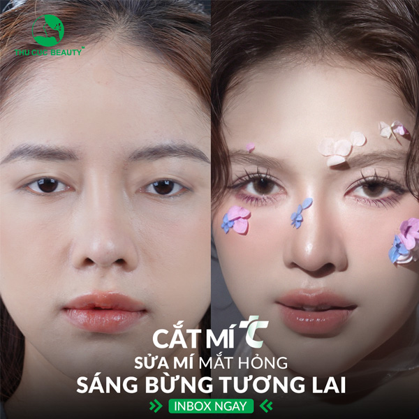 Chỉnh sửa cắt mí mắt hỏng