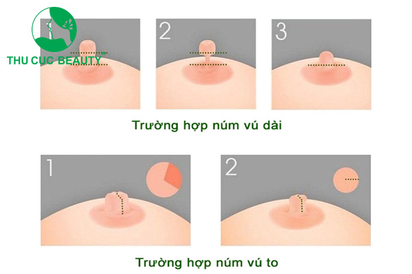 Thu gọn núm vú (đầu ti)