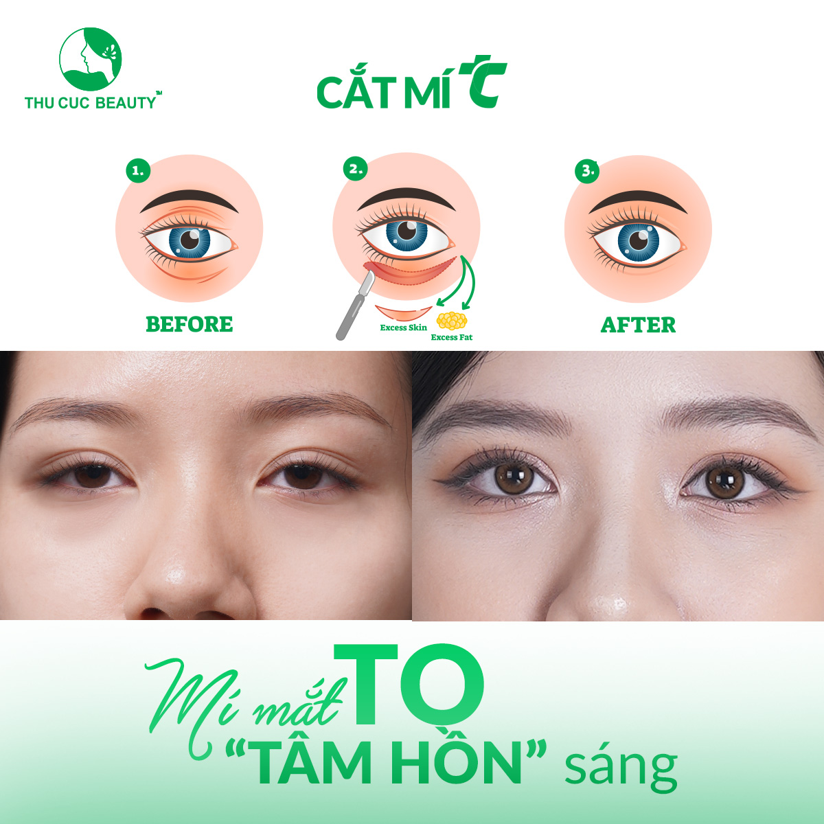 Cắt da thừa mí dưới