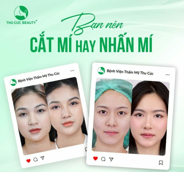 Nhấn Mí Mắt 3 nhan mi hay cat mi e1784105750866