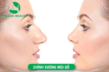 Chỉnh xương mũi gồ