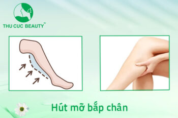 Hút mỡ bắp chân