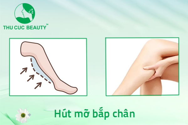 Hút mỡ bắp chân