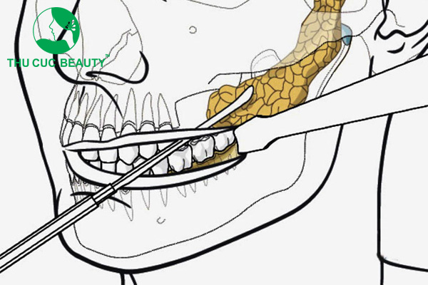 Hút mỡ má giúp gương mặt trở nên thanh thoát, cân đối hơn.