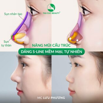 Nâng mũi cấu trúc 