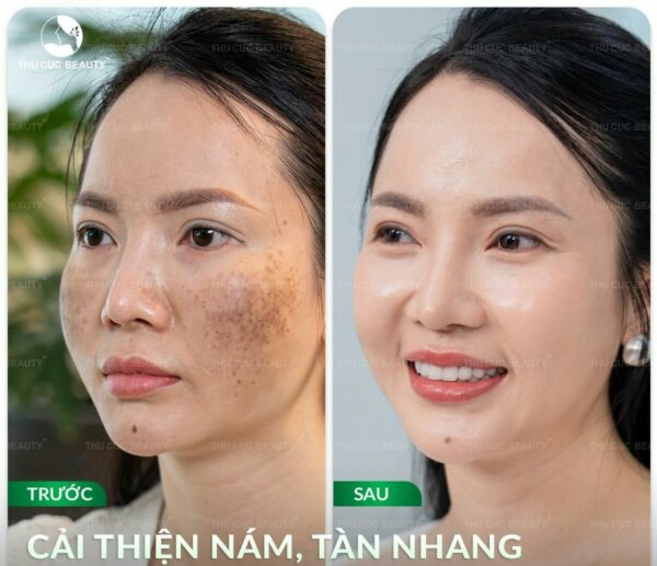 ban laser tri nam e1784284799921