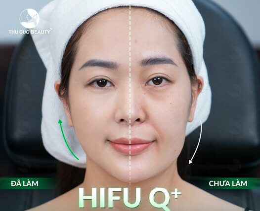 Trẻ hóa bằng công nghệ siêu âm Hifu 