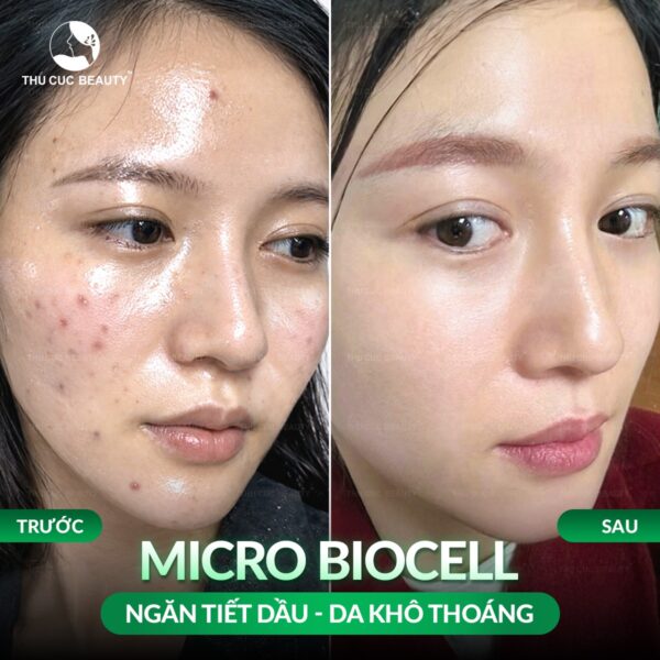 da noi mun co tiem meso duoc khong e1784258440312