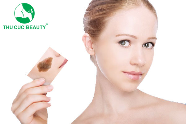 Điều trị bớt sắc tố – Đồi mồi – Tăng sắc tố