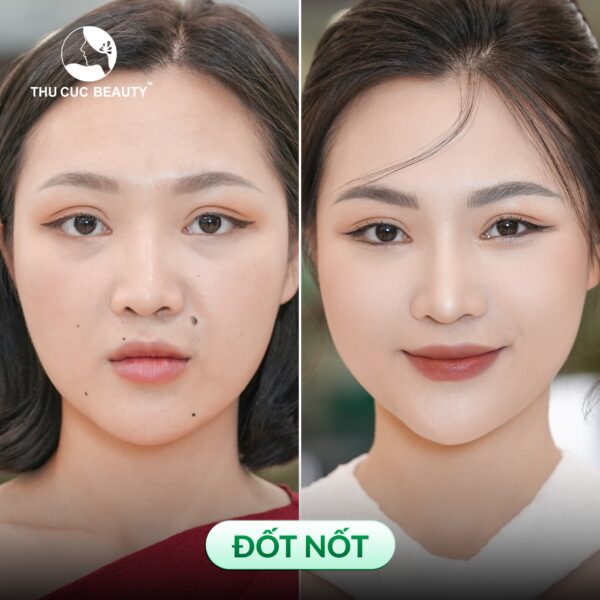 Đốt nốt hiệu quả, an toàn tại Thu Cúc.