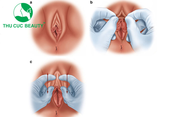 Thu gọn mũ âm vật 