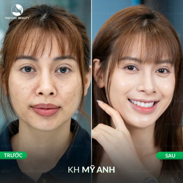 tiem meso tri tham e1784258514395
