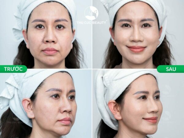 Trẻ hóa bằng công nghệ siêu âm Hifu 2 tre hoa bang cong nghe hifu e1784259302862