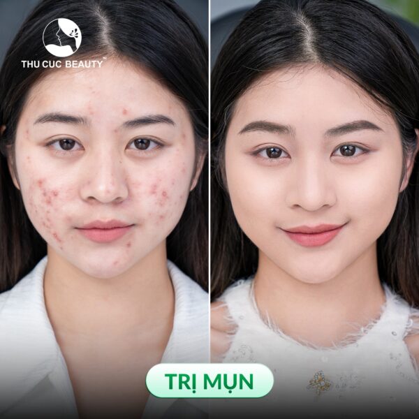 Trị mụn hiệu quả tại BVTM Thu Cúc.
