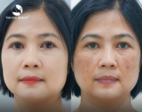 Trị nám TC: Giải pháp hiệu quả hiện nay 1 tri nam da 1 e1768189568795