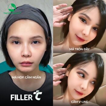 Giá tiêm filler hiện nay là bao nhiêu?