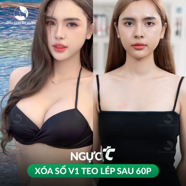 Nâng ngực giúp cải thiện kích thước vòng 1 trở nên gợi cảm hơn.