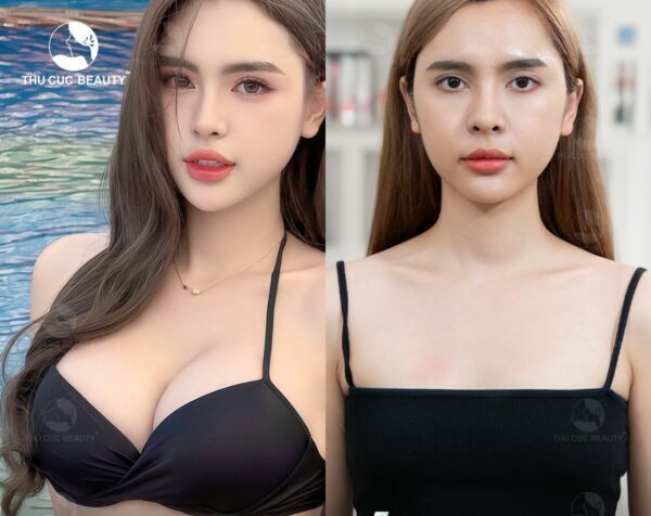 Nâng ngực giúp cải thiện kích thước vòng 1 trở nên gợi cảm hơn.