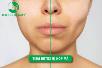 Tiêm botox gọn hàm có bị hóp má không?