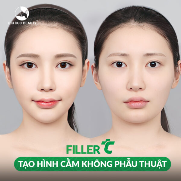 Tiêm filler tạo hình cho khuôn mặt đầy đặn, cân đối và xinh đẹp hơn.