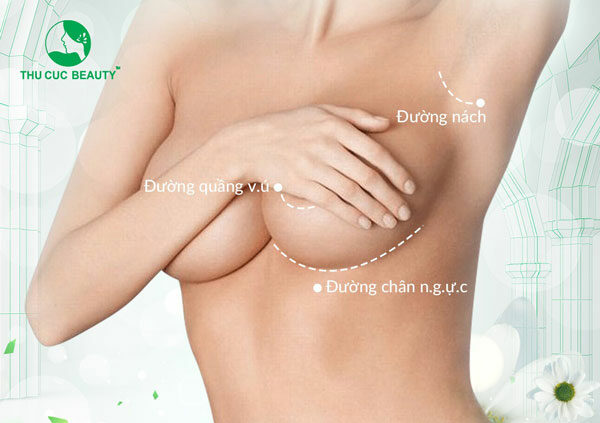 Vị trí đường mổ nâng ngực.