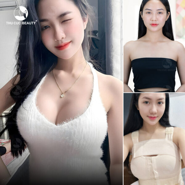 Có nên nâng ngực trước khi sinh con không?