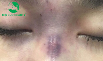 Tiêm filler có hại không? Những rủi ro cần biết khi tiêm filler