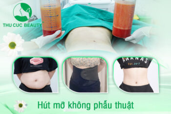 Hút mỡ bụng phải nịt bụng bao lâu?