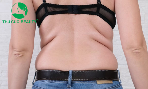 Hút mỡ lưng giúp loại bỏ mỡ thừa nhanh chóng.