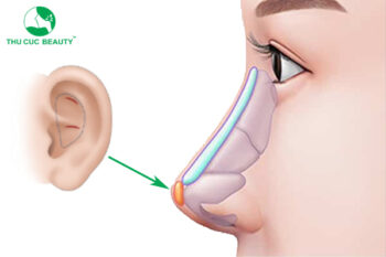 Nâng mũi sụn tai có bị teo không?
