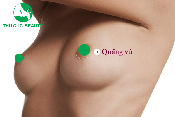 Nâng ngực đường quầng có cho con bú được không? 1 Nâng ngực đường quầng vú có cho con bú được không?