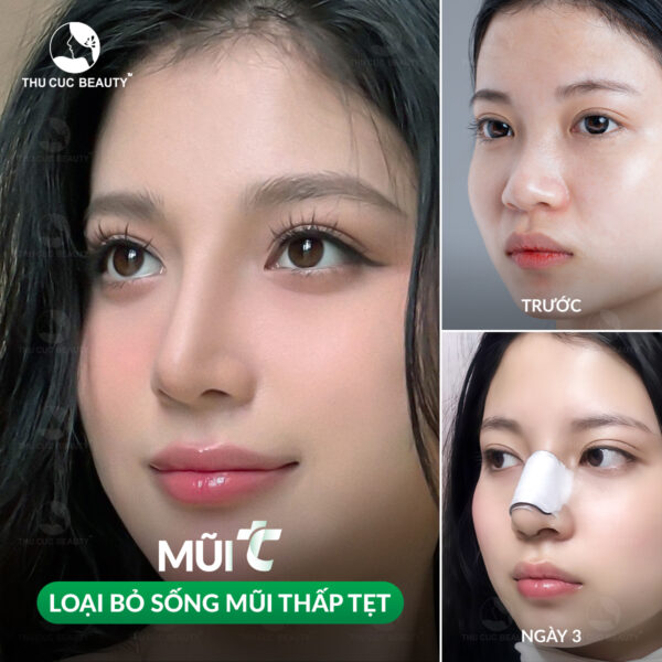 Tuổi thọ của nâng mũi được bao lâu? Phương pháp nào bền nhất? 1 Tuổi thọ của nâng mũi được bao lâu?