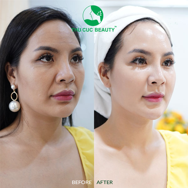 Những lưu ý cần biết để căng da mặt an toàn 3 Căng da mặt bằng công nghệ HIFU