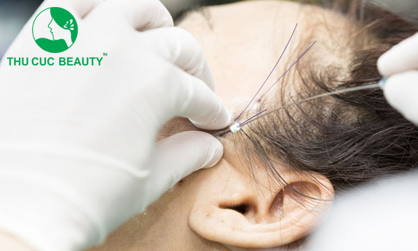 Những lưu ý cần biết để căng da mặt an toàn 2 Căng chỉ da mặt