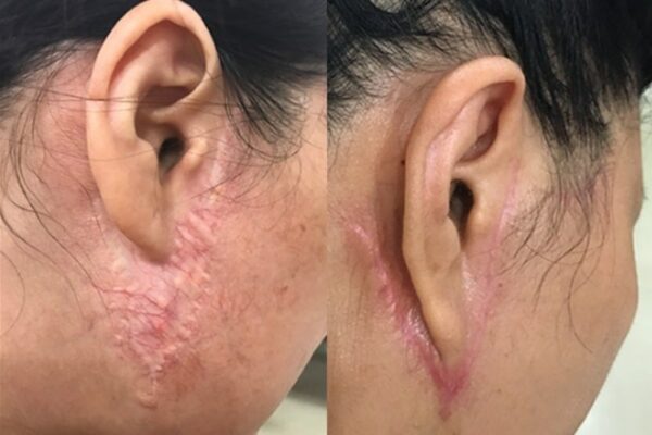 Phẫu thuật căng da mặt có nguy hiểm không? 2 cang da mat co an toan khong e1756461861752