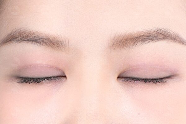 Cắt mí bao lâu thì hết sẹo? Làm sao để sẹo cắt mí nhanh lành? 1 Cắt mí bao lâu thì hết sẹo?