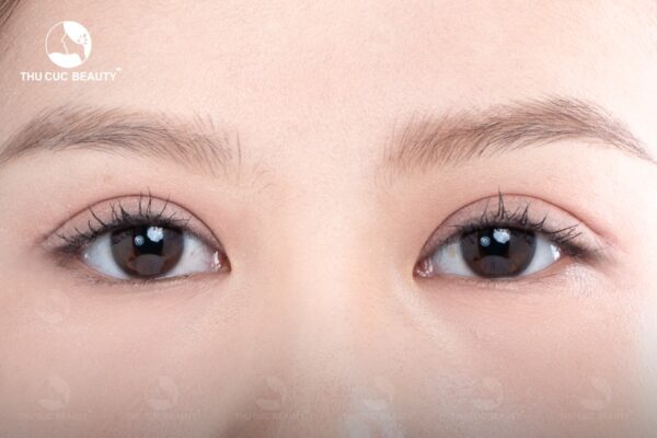 Cắt mí bao lâu thì hết sẹo? Làm sao để sẹo cắt mí nhanh lành? 2 Cắt mí bao lâu thì hết sẹo?