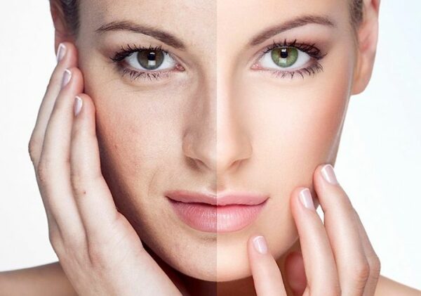 Tiêm HA là gì? Những điều cần biết về tiêm HA 2 Tiêm HA là phương pháp làm đẹp được nhiều người ưa chuộng.