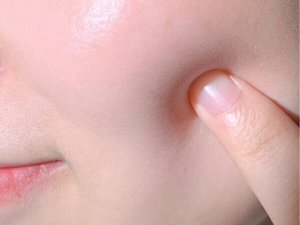 Tiêm HA là gì? Những điều cần biết về tiêm HA 3 Tiêm HA giúp bổ sung độ ẩm cho làn da một cách nhanh chóng.