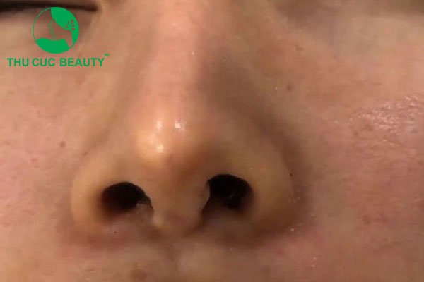 Nâng mũi bao lâu thì tụt? Làm sao để tránh bị tụt sống mũi sau nâng? 1 Nâng mũi bao lâu thì tụt?